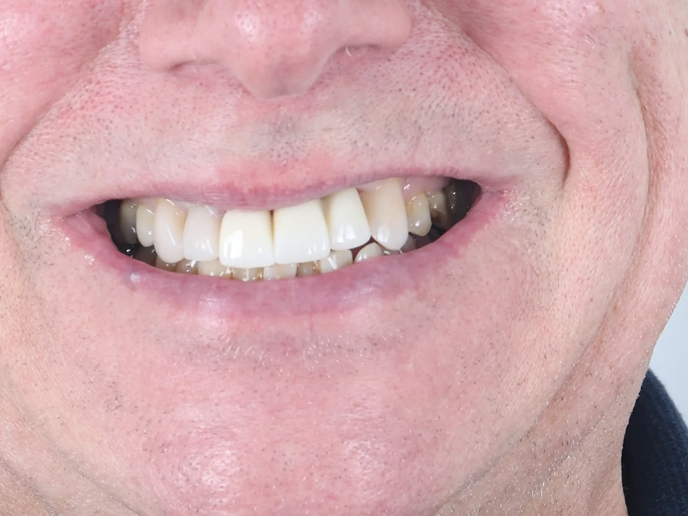 Broken front tooth & gum disease — final results