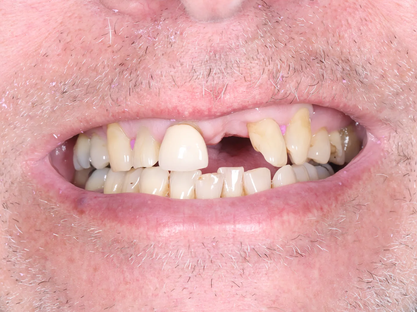 Broken front tooth & gum disease — pre-op