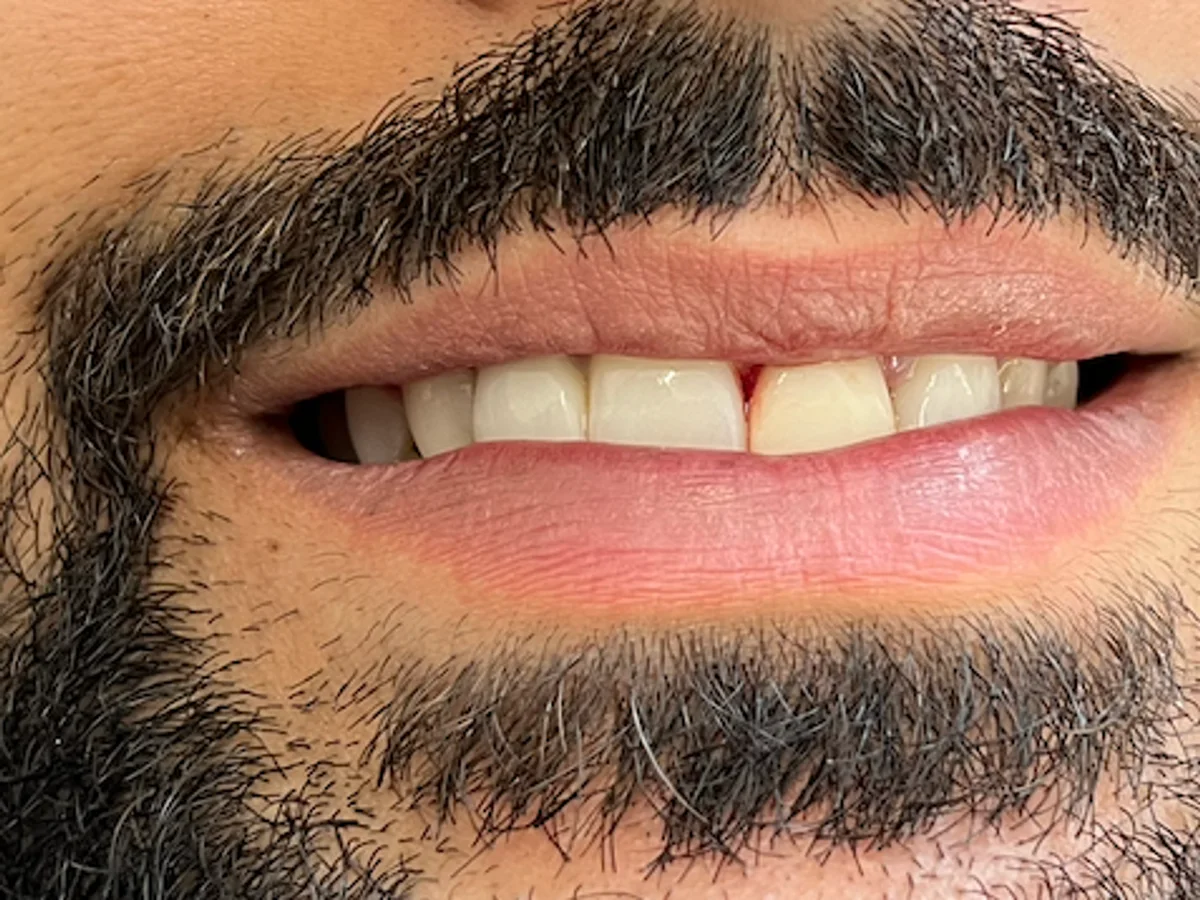 Complex rebuild after a childhood accident — pre-op