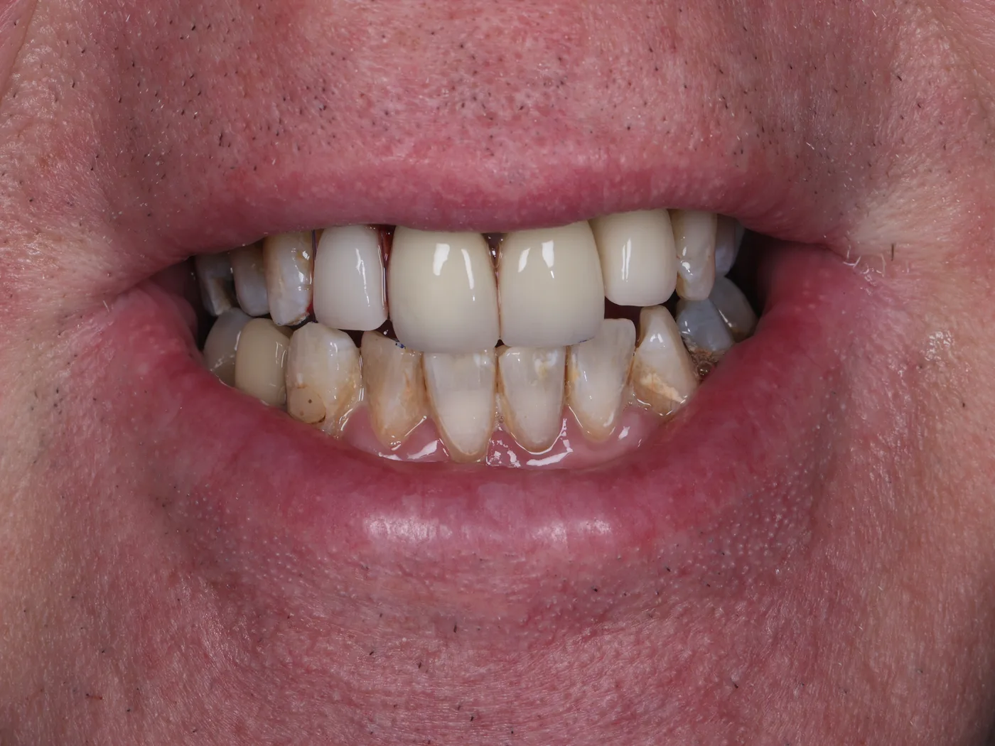 Fractured front tooth, rebuilt — final results
