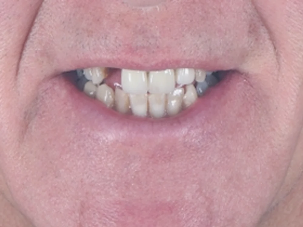 Fractured front tooth, rebuilt — pre-op
