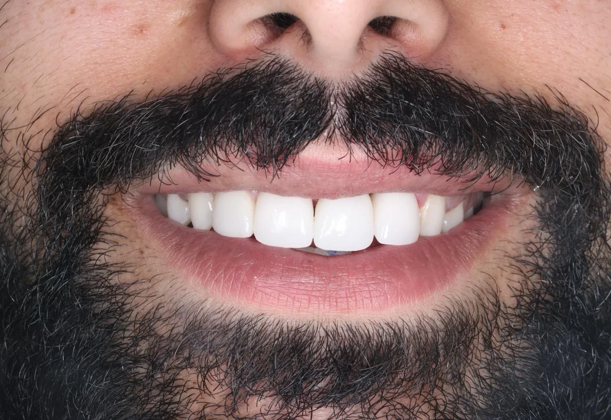 Complex rebuild after a childhood accident — anonymised patient result