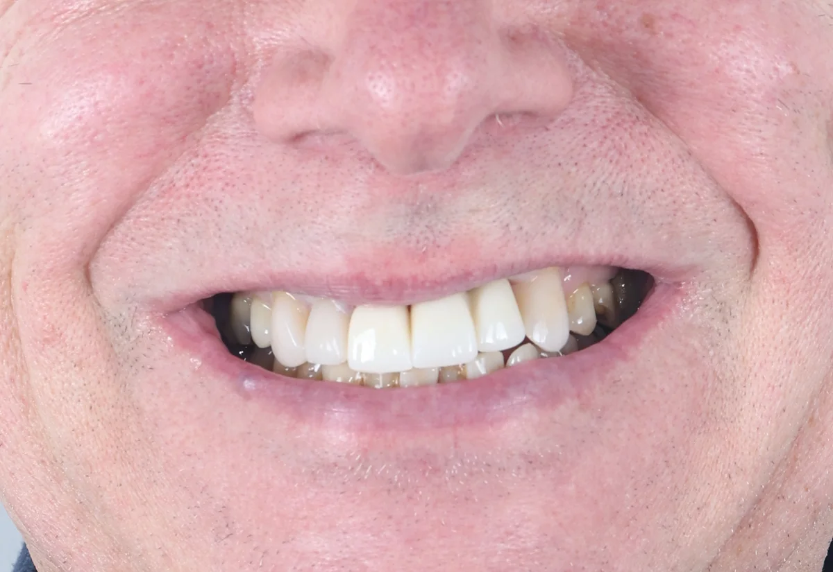Broken front tooth & gum disease — anonymised patient result