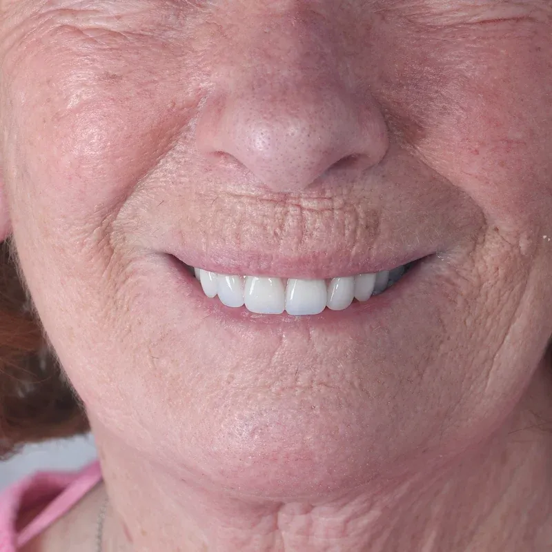 After: Smile makeover — by Dr Ravinder Singh Jhutie