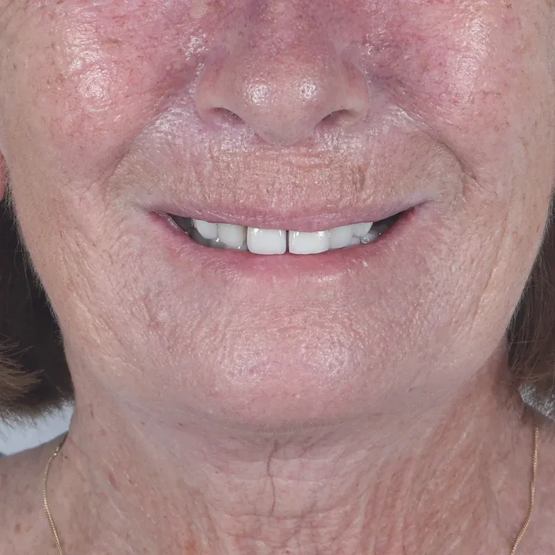 Before: Smile makeover — by Dr Ravinder Singh Jhutie