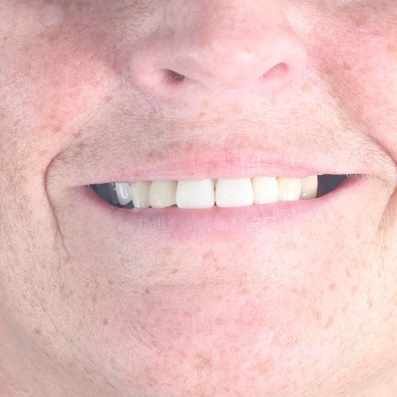After: Single front-tooth implant — by Dr Ravinder Singh Jhutie