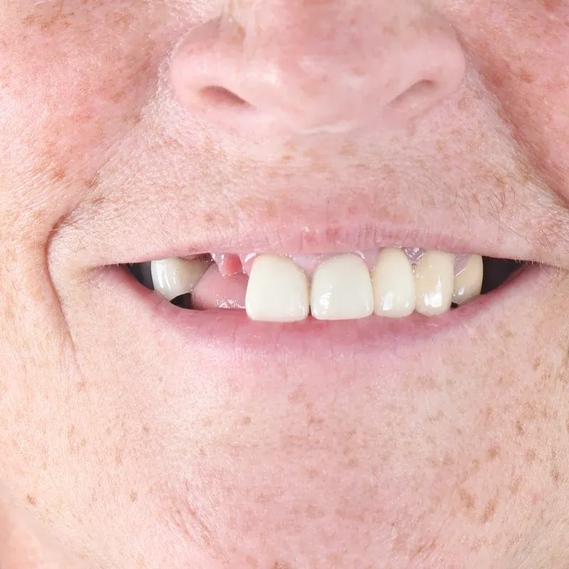 Before: Single front-tooth implant — by Dr Ravinder Singh Jhutie