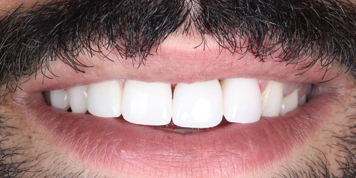 After: Front-tooth implant & crown — by Dr Ravinder Singh Jhutie