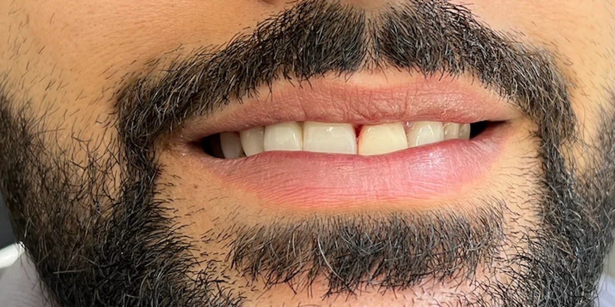 Before: Front-tooth implant & crown — by Dr Ravinder Singh Jhutie