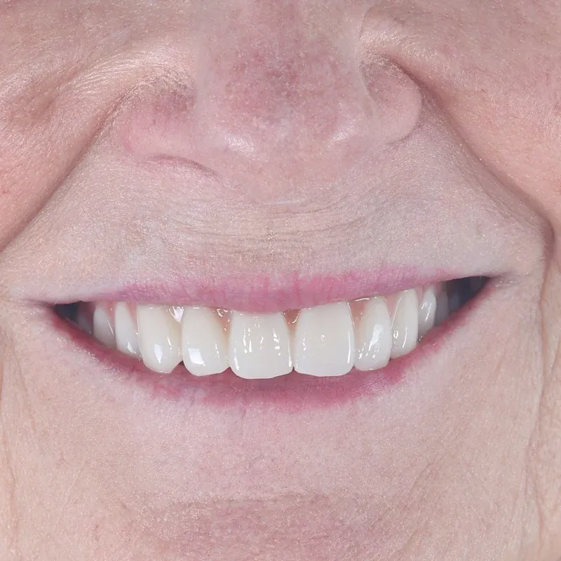 After: Full upper arch on implants — by Dr Ravinder Singh Jhutie