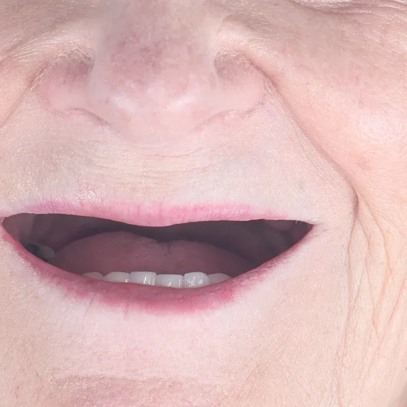 Before: Full upper arch on implants — by Dr Ravinder Singh Jhutie