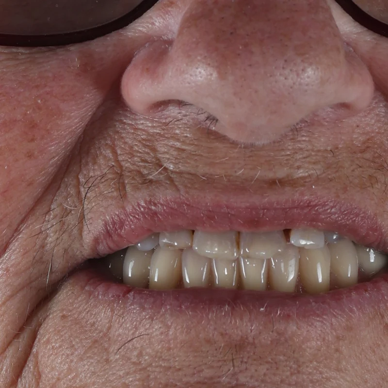 After: Full lower arch on implants — by Dr Ravinder Singh Jhutie