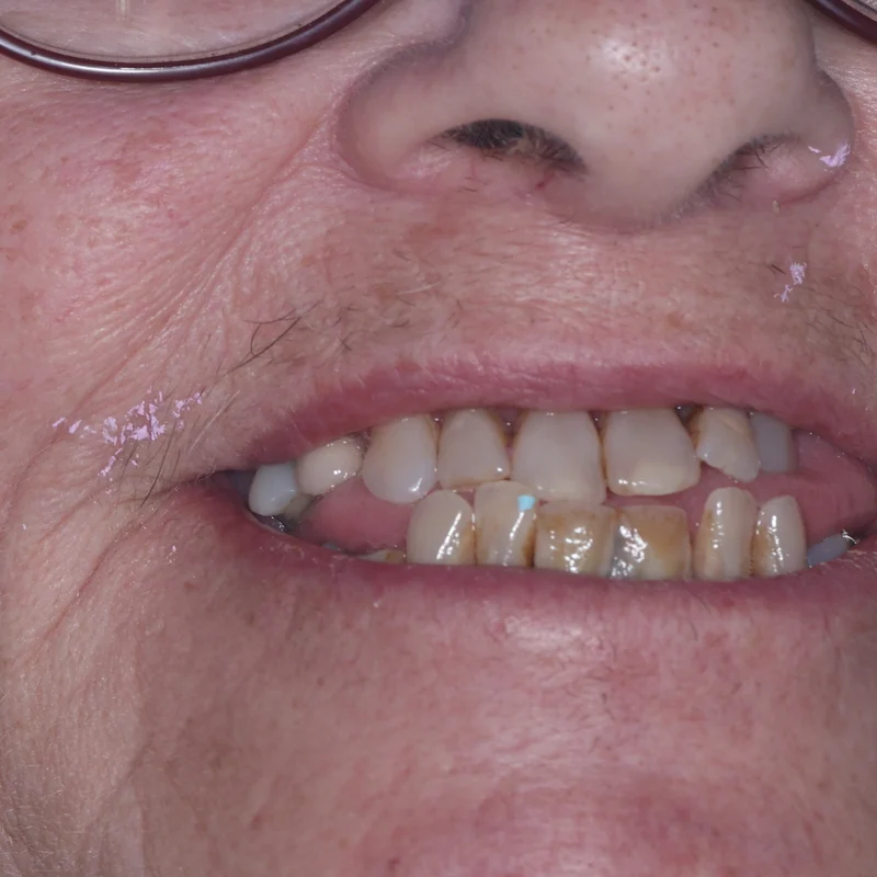 Before: Full lower arch on implants — by Dr Ravinder Singh Jhutie
