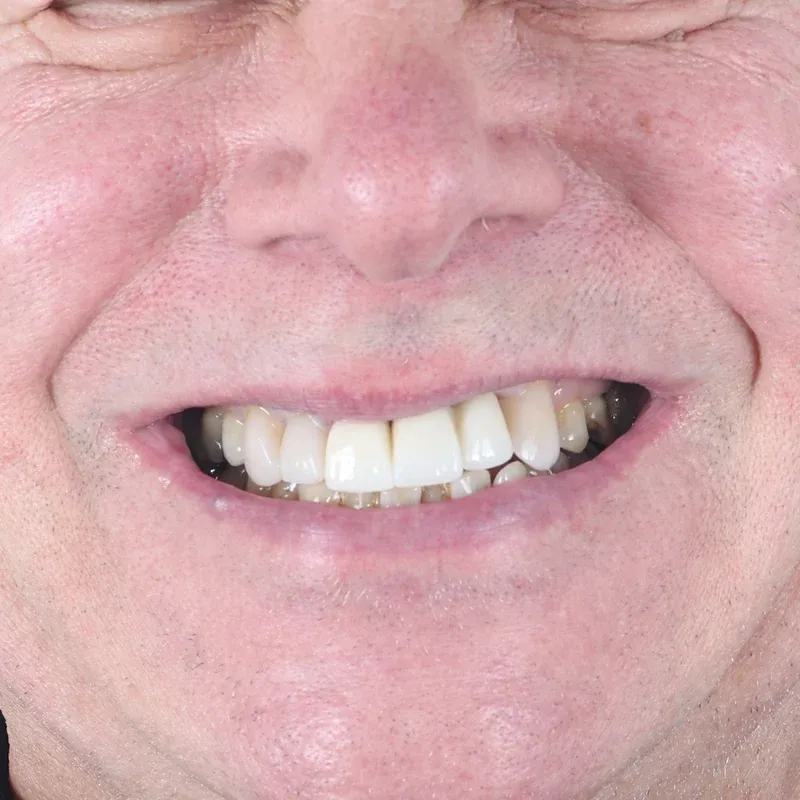 After: Composite & whitening makeover — by Dr Ravinder Singh Jhutie
