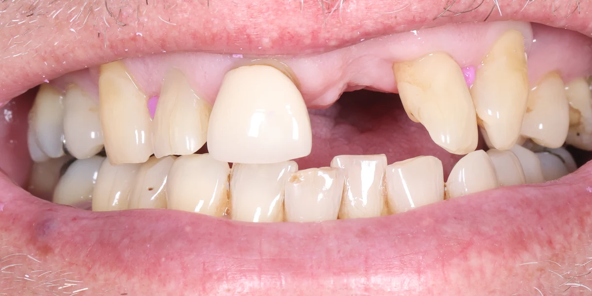 Before: Composite & whitening makeover — by Dr Ravinder Singh Jhutie