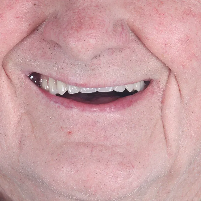 After: Full mouth rehabilitation — by Dr Ravinder Singh Jhutie