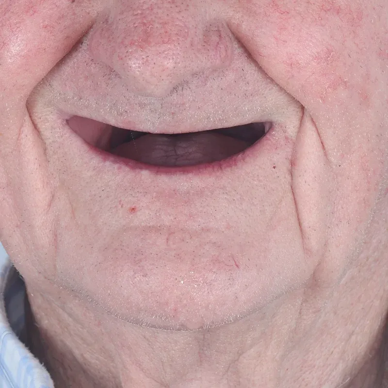 Before: Full mouth rehabilitation — by Dr Ravinder Singh Jhutie