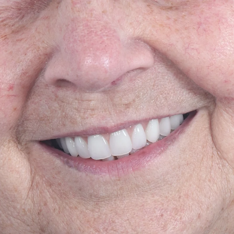 After: All-on-4 upper (full-mouth) — by Dr Ravinder Singh Jhutie