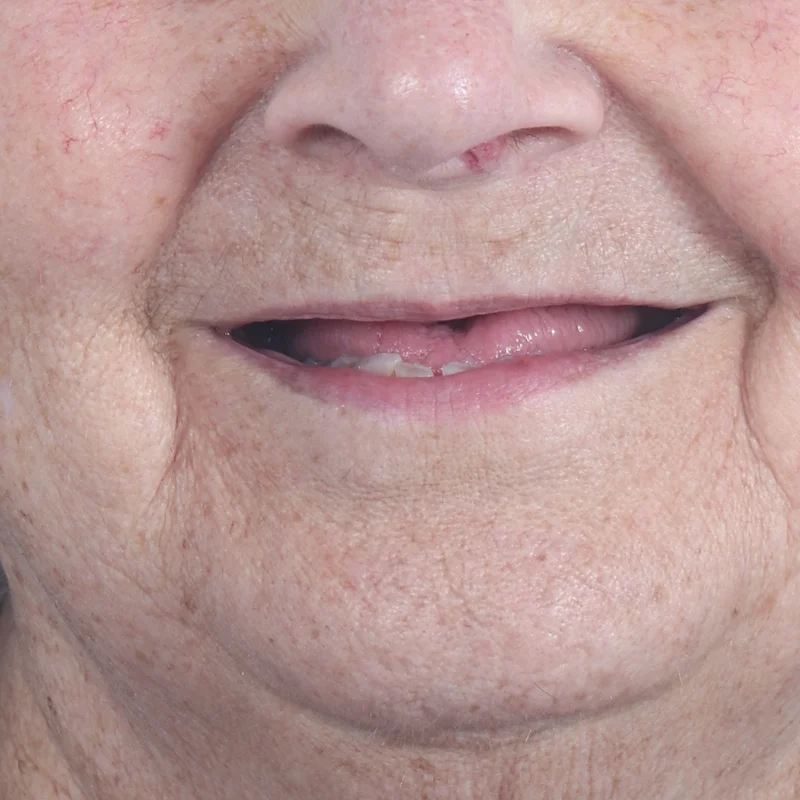 Before: All-on-4 upper (full-mouth) — by Dr Ravinder Singh Jhutie