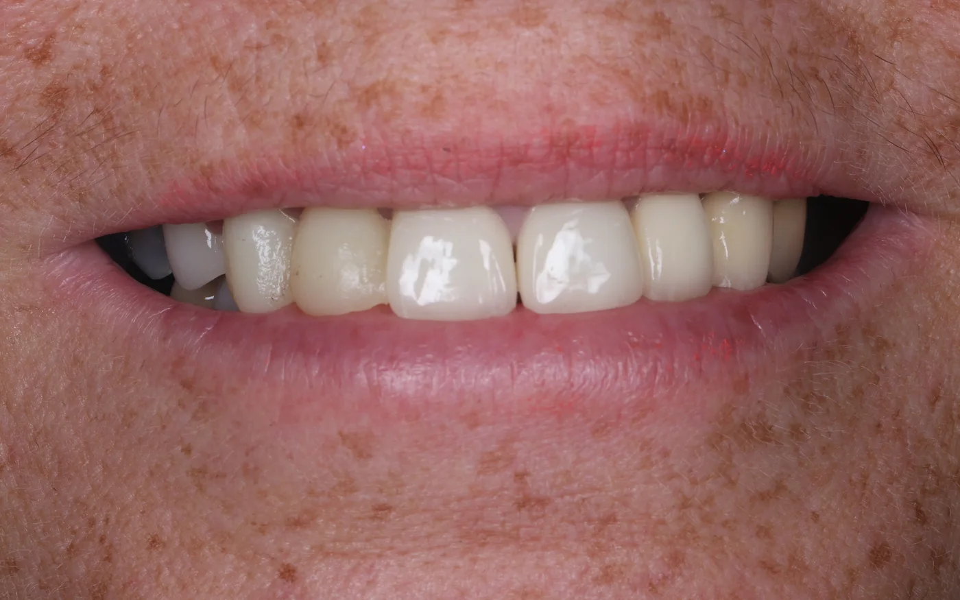 Anterior aesthetic implants