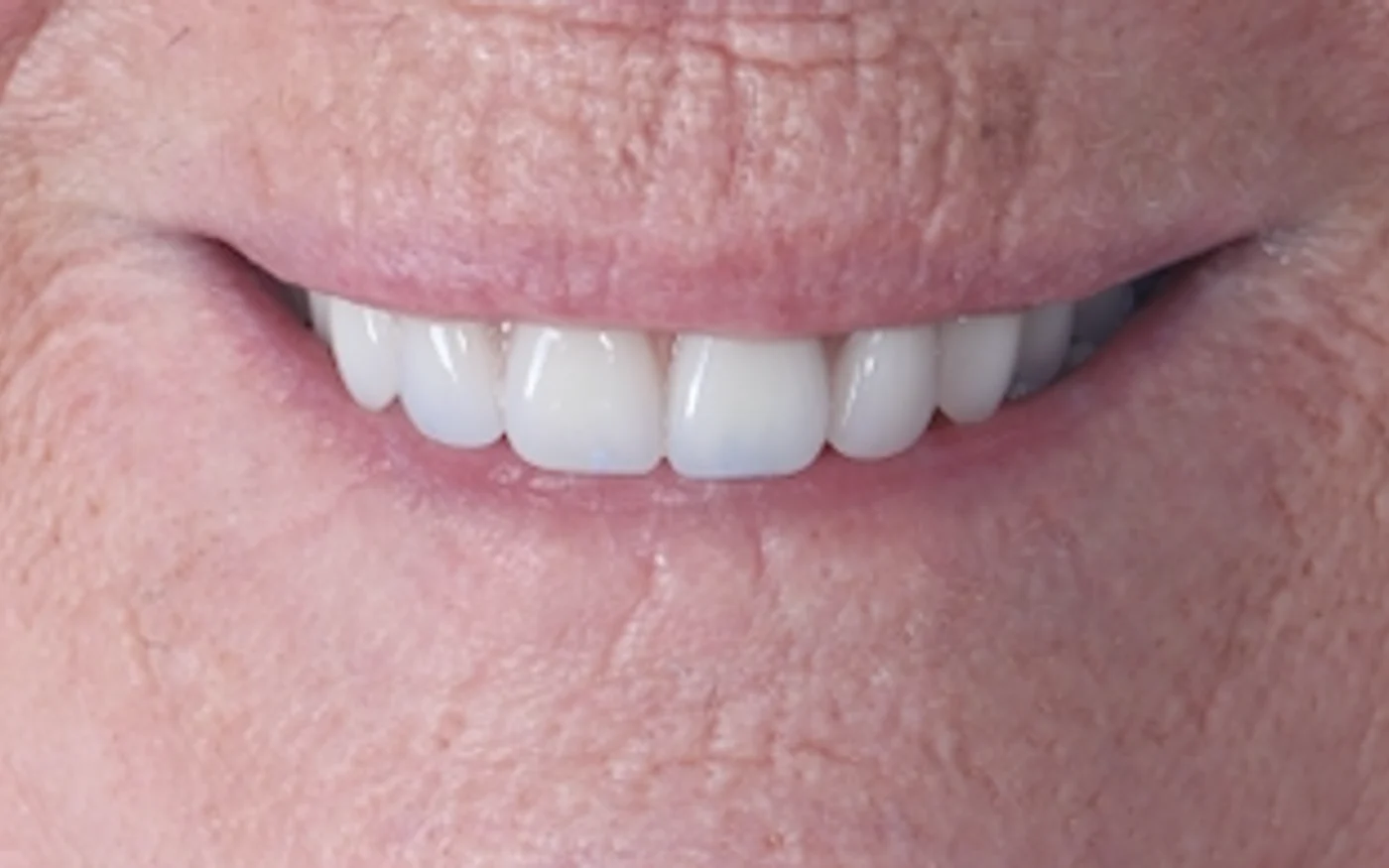 Smile makeovers